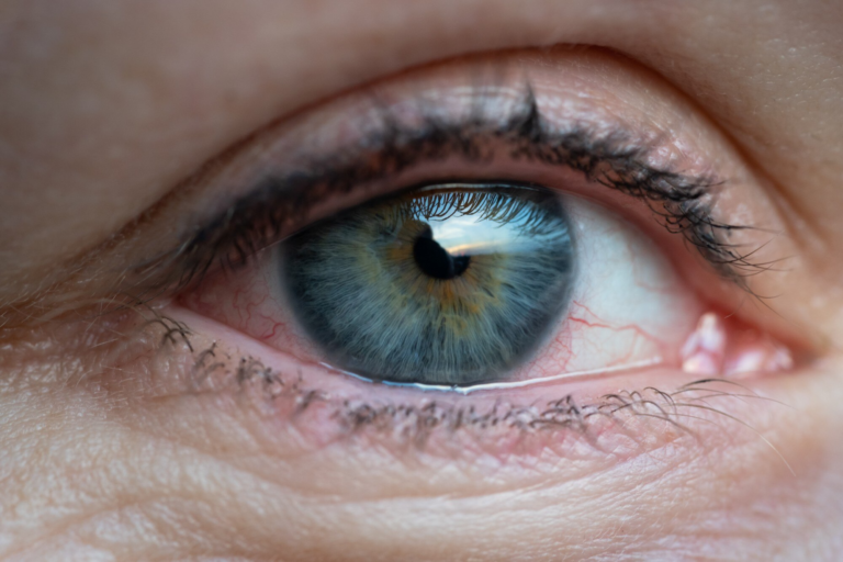 Bimatoprost eye
