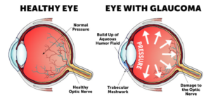 Glaucoma