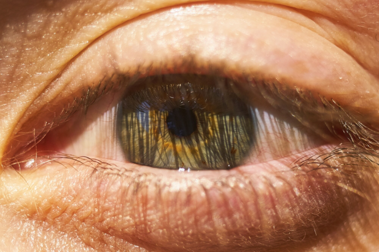 glaucoma