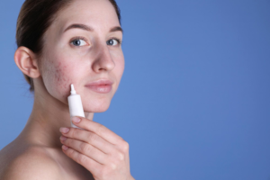 Best Treatment for Acne: Adapalene Gel or Clindamycin Gel?