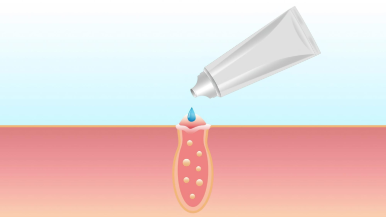 Adapalene Gel